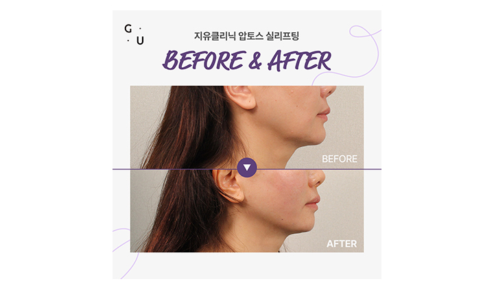 턱리프팅시술, 유지력까지 고려한다면 강남 압토스 실리프팅