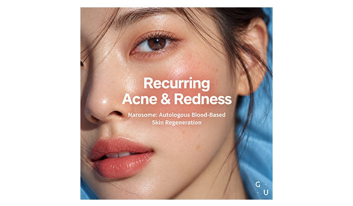 Narosome: An Autologous Blood-Based Regenerative Treatment for Recurring Acne and Redness