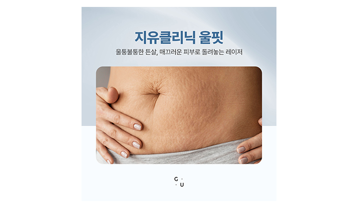 출산 후 튼살 관리, 강남역출산튼살 케어 울핏으로 개선해보기