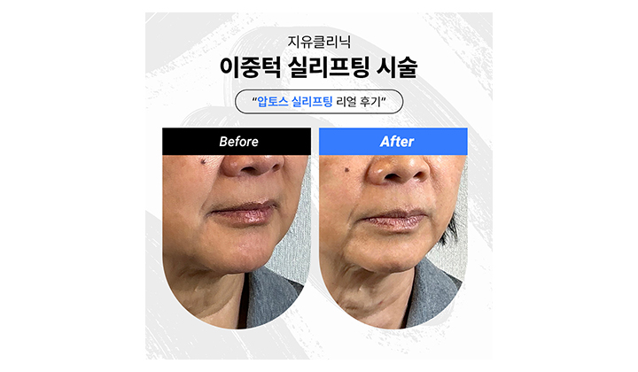 이중턱살 빼는 법, 강남역압토스로 바꾸는 턱선 라인