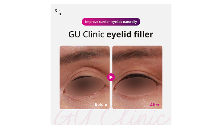 Gangnam eyelid filler for hollow eyelid correction