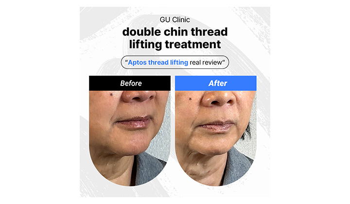 Double chin reduction with Aptos jawline lifting
