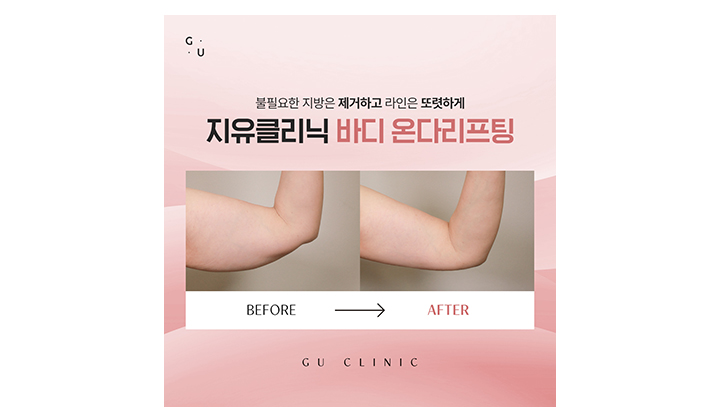 처진 팔뚝 라인을 다듬어주는 강남바디리프팅 