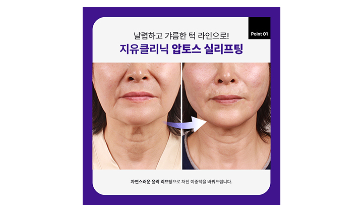 강남역이중턱시술, 제거보다 중요한건 '정리'입니다. 