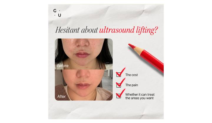 HIFU Lifting in Seoul: ULTLINE for the Face and Body
