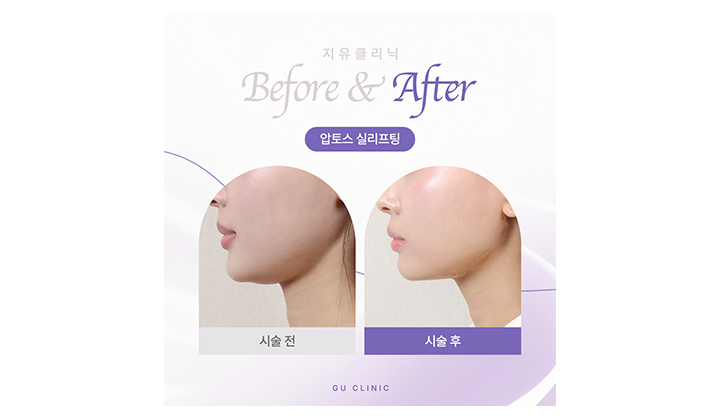 Gangnam contouring for double chin—what’s key?