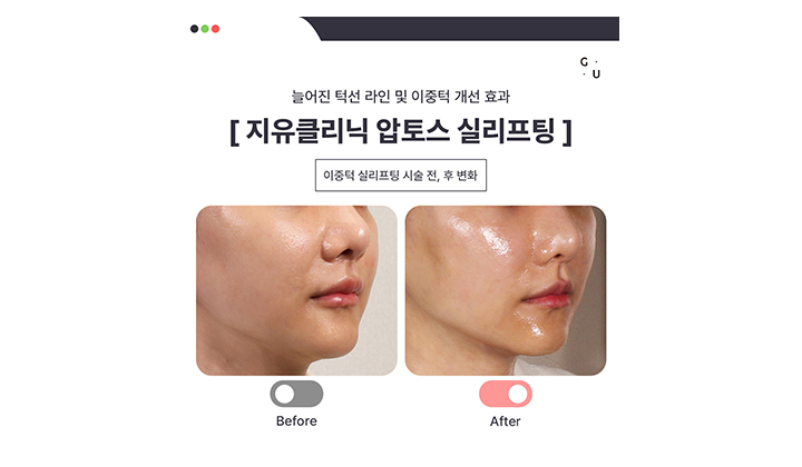 압토스 실리프팅, 후기만으로 효과를 평가할 수 없습니다
