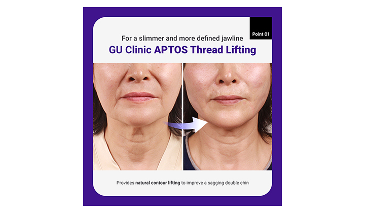 Double chin treatment focused on contouring