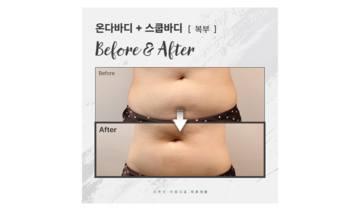 뱃살안빠짐이 고민이라면? 일산 온다바디·스쿱바디 사례