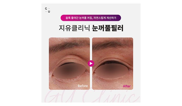 눈꺼풀 꺼짐, 자연스러운 개선을 원한다면 일산눈꺼풀필러