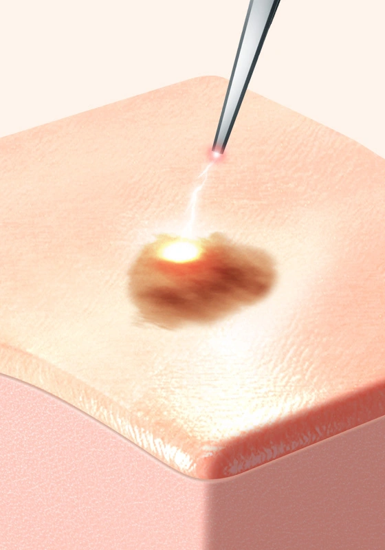 Laser Lifting